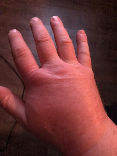 Meine Hand nach Wespen Stichen