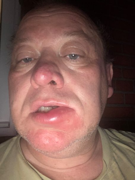 Dummes Gesicht nach Stichen von Bienen in die Lippe